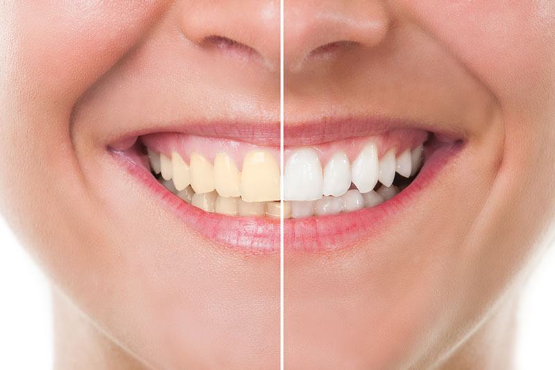 Teeth Whitening - Bronson Dental, Cincinnati Dentist